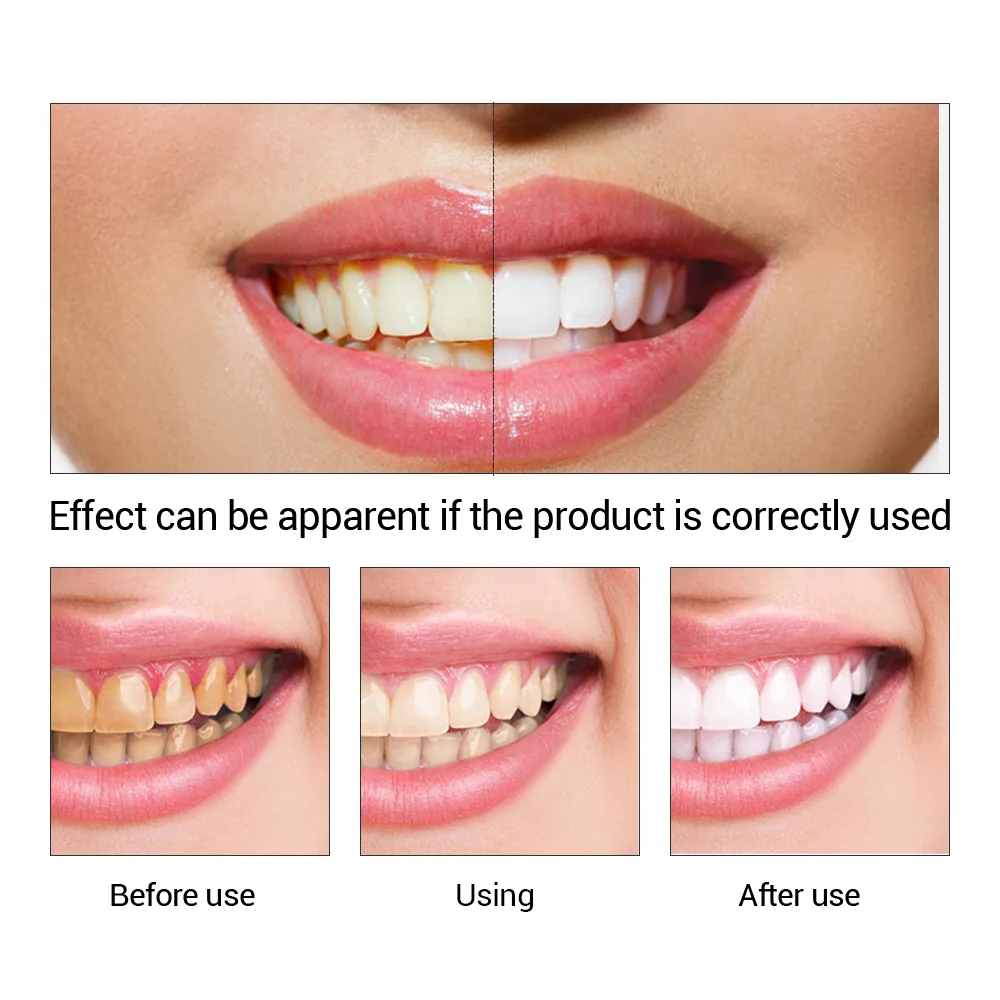 FTEENPLY Teeth Whitening Essen - Teeth Whitening/Bleaching ulasan dan harga