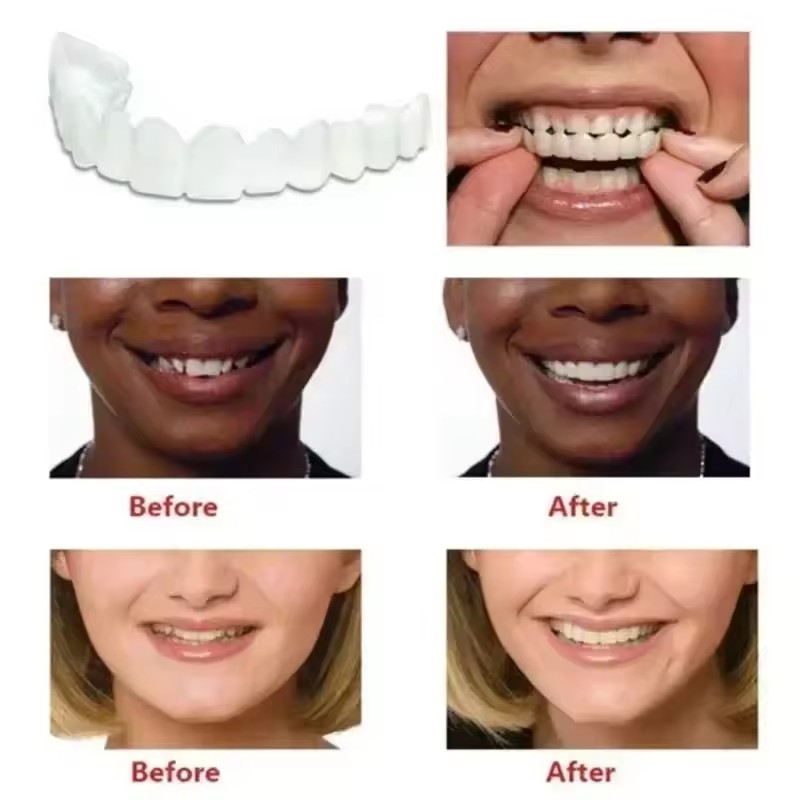 Teeth Veneers Whitening Dentur - Teeth Whitening Kit ulasan dan harga