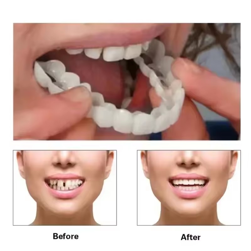 Teeth Veneers Whitening Dentur - Teeth Whitening Kit ulasan dan harga