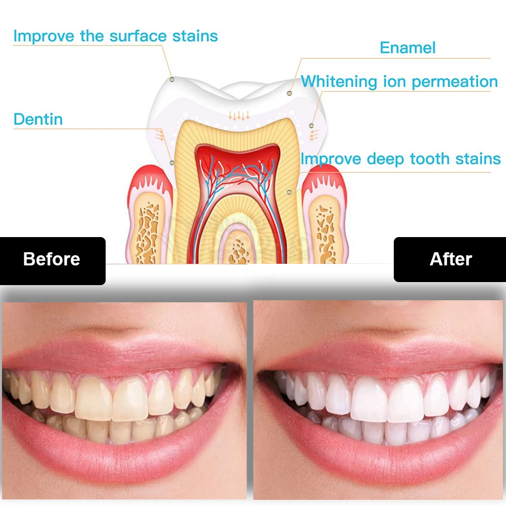 Dental Teeth Whitening Kit Min - Teeth Whitening Gel Pen ulasan dan harga